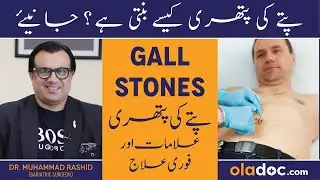 Gallbladder Stones Symptoms - Pitay Ki Pathri Ka Ilaj In Urdu - How To Treat Gallbladder Stones