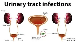 URINARY TRACT INFECTION#youtube #utiinfection #urineproblem #urineproblems