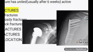 upper arm ((humerus))