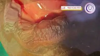 निचले जबड़े में Cortical Implant | Same Day Fixed Teeth | Immediate Implant Case Dr Rajkumar