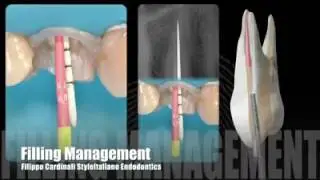 Style Italiano endo   TIP for filling management on deep canal bi furcation