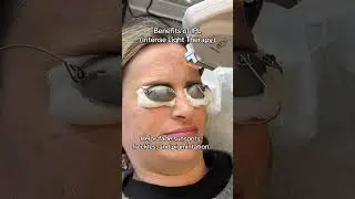 Benefits of IPL Treatment #ipl #ipltreatment #aesthetics
