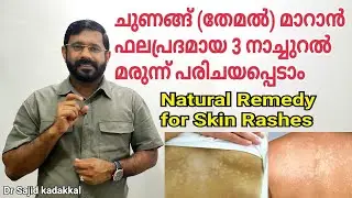 ചുണങ്ങ് (തേമൽ) മാറാൻ വളരെ ഫലപ്രദമായ 3 നാച്ചുറൽ റെമഡി