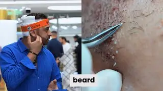 Beard transplant 