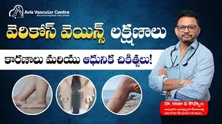 Varicose Veins Causes, Symptoms & Treatment | Dr. Rajah V Koppala || Avis Hospitals