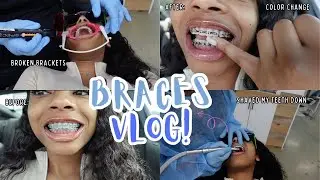 BRACES VLOG | COME WITH ME TO GET MY COLOR CHANGED + Broken brackets + Shave my teeth down 😄✨