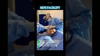 Mini Facelift Surgery & Results ✨ | #minifacelift #facelift #jawline #plasticsurgeon #plasticsurgery
