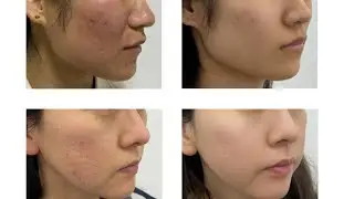 1927nm Fractional Thulium Laser | FDA, CE, MDSAP Certified Skin Rejuvenation System | Sinako Medical