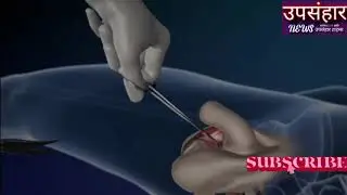 जानिये कैसे होती है मेल से फीमेल जेंडर चेंज सर्जरी Gender Change from male to female by operation
