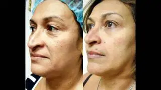 Angelic Lift Eighth Week Results