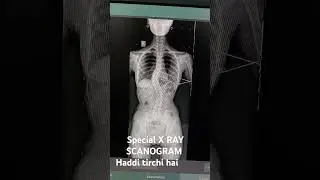 SPECIAL X RAY SCANOGRAM