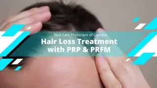 Hair Loss Treatment: What Is Platelet Rich Plasma?