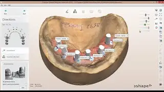 How to create an Implant Bar Order in 3Shape Dental System 2015