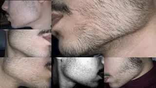 my minoxidil beard journey | I have a beard now...