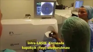 Intra-LASIK yapılışı