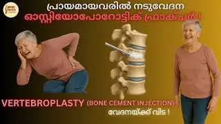 (Vertebroplasty-Bone cement Injection) ഓസ്റ്റിയോപോറോട്ടിക് ഫ്രാക്ചറിനുള്ള ഫലപ്രദമായ ചികിത്സാമാർഗം