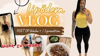 Liposuktion bei Lip&ouml;dem mit Laser-Lipo Post OP Woche 1