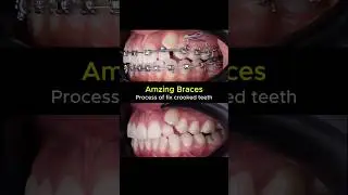Amazing braces. Process of fix crooked teeth #braces #dentist #orthodontist #smilemakeover #teeth