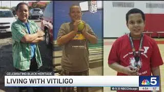 Scientist makes breakthrough in vitiligo research