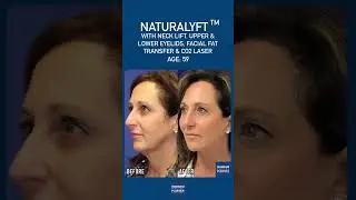Facelift by Dr. Madnani NYC top facial plastic surgeon #jawlinelift #facelift #drmadnani