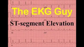 Подъём сегмента ST на ЭКГ — Вопрос 9.0 | The EKG Guy