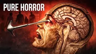 The Lobotomy Was SO Much Worse Than You Think
