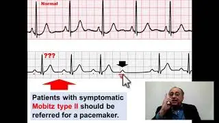 Mobitz type II AV Block #cme #internal_medicine #pharmaceutical #medical #doctor   #محاضرات_باطنة