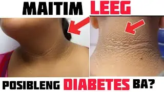 Maitim Leeg: Posibleng Diabetes ba? &ndash; by Doc Willie Ong #951