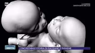 Separate gemelline siamesi algerine unite per l'addome e il torace - La vita in diretta 11/05/