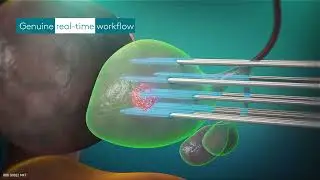 Prostate Cancer Treatment 3D Animation