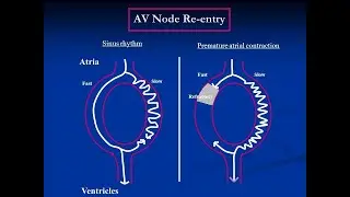 AV Nodal Reentry Supraventricular tachycardia ; Definition, Causes, Symptoms, Treatment