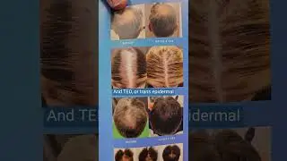 Non-Surgical Hair Restoration Treatment with Alma TED Explained