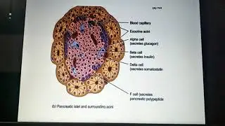Diabetes  milletus