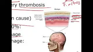 Adult Health Nursing 2: Neurologic Dysfunctions - Cerebrovascular Accident (CVA) - Ischemic Stroke