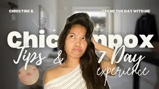 Things I Wish I Knew Before Having Chickenpox | Symptoms, Remedies, Do&rsquo;s & Don&rsquo;ts (Day 7 Experience)