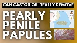 Castor Oil for Pearly Penile Papules: Truth, Myths, and Alternatives