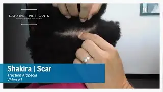 Fine Pencil Line Scar: Incredible Healing After Hair Transplant |  Dr. Siegel (Shakira)