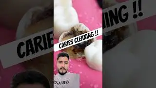 Caries tooth cleaning #satisfying #dentist #oddlysatisfying #dentalartistry #smallbusiness #dental