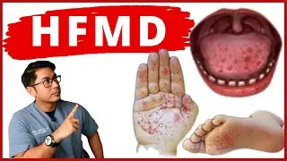 Tanda Awal HFMD | Penyakit Tangan Kaki & Mulut | Doctor Sani |