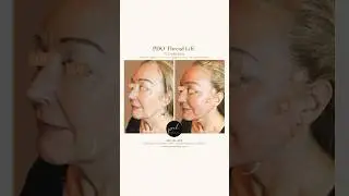 Fix Turkey Neck with PDO Thread Lift and Instalift, PCH MedSpa