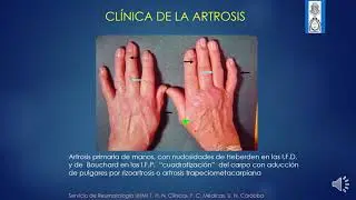 Artrosis