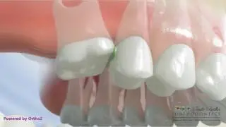 Ectopic Molar Eruption - Orthodontic Treatment