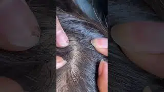 (Part 32) Lice Removal & Treatment Satisfying Lice Popping #lice #liceremoval #satisfying