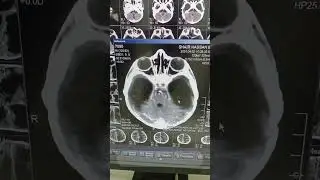 Normal CT scan of the brain | Live from operator room