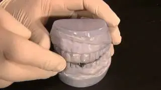 NTI-tss Plus appliance and Veneers