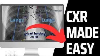 Chest X-ray interpretation made EASY