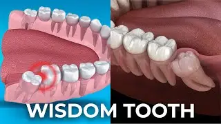 Understanding Your Wisdom Teeth | A Guide to Pain, Relief, and Expert Care at Hash Dental Clinic