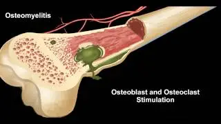 Hyperbaric Oxygen Indication-Skeletal System