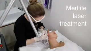 Pigmentation treatment with Medlite laser | Cityskin Melbourne
