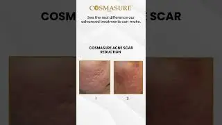 Real Acne Scar Transformation | Cosmasure before after